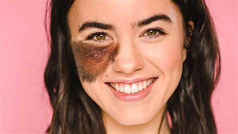 hairy cassandra|Living with birthmarks: What are the ones you can and cannot .
